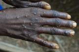 La RDC, épicentre mondial de la variole du singe en 2023