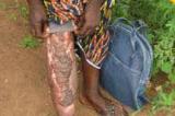 Sud-Ubangi : plus de 450 cas de la maladie d'ulcère de Buruli recensés dans la zone de santé de Bogose Nubea