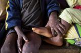 Variole du singe : l’OMS vient en appui à la RDC pour vaincre l’épidémie