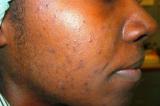 Quelles solutions pour limiter les rougeurs et imperfections liées à l’acné ?