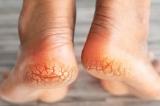 4 soins naturels pour traiter la crevasse des pieds