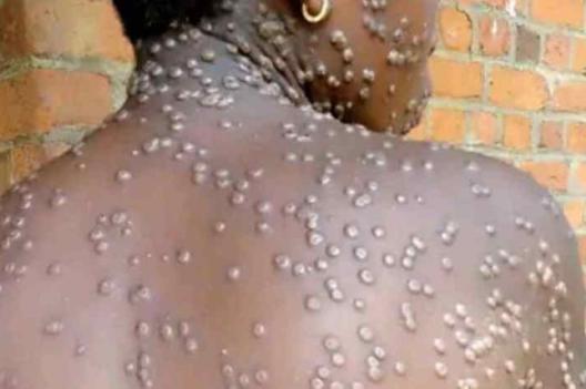 Maniema : des cas de Monkey pox notifiés dans la zone de santé rurale de Lubutu