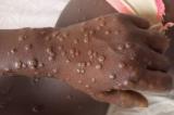 Kasaï-Oriental : deux nouveaux cas de Mpox notifiés