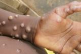 Maniema : l'épidémie de Monkeypox ravage la population, plus de 60 cas enregistrés dont 12 décès