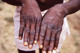 Maniema : 199 cas, dont 19 décès, d’une maladie semblable au Monkey Pox enregistré dans le territoire de Kibombo