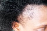 Qu'est ce qui provoque la chute des cheveux ?