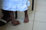 Maniema : 87 enfants guéris de la malformation de pied bot en 2023