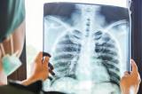 Dans un rapport : l’oms note une augmentation du nombre de cas de tuberculose et de décès dus à la maladie pendant la pandémie de covid-19