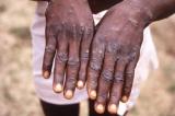 Lutte contre la variole du singe : l'UE à la rescousse de la RDC avec 350.000 €  
